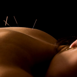 Towson Acupuncture